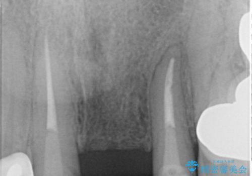 前歯ブリッジのやりかえの治療中