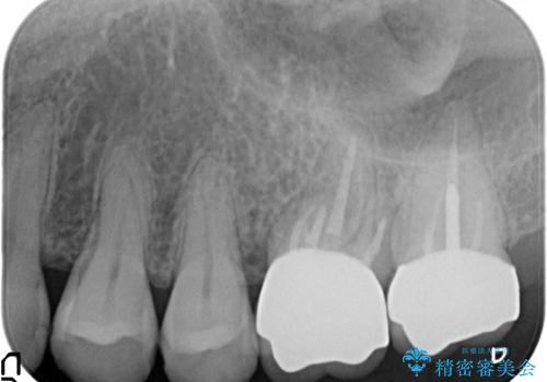 オールセラミッククラウン 疼く奥歯の治療の治療後