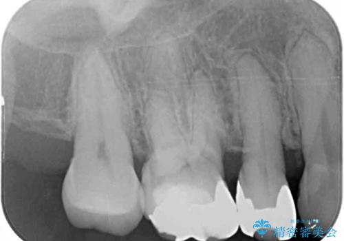 奥歯の深い虫歯をオールセラミックで治療の治療前