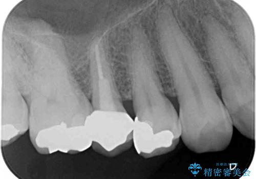 古くなったメタルボンドをオールセラミッククラウンにの治療後