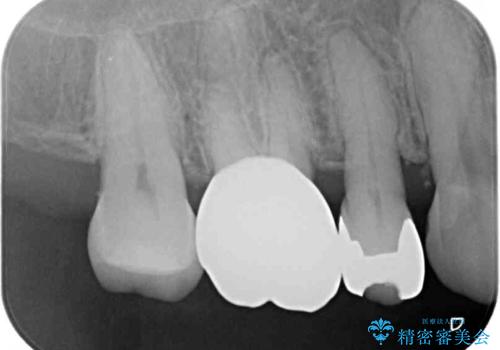 奥歯の深い虫歯をオールセラミックで治療の治療後