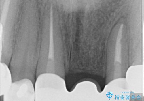 前歯ブリッジのやりかえの治療後