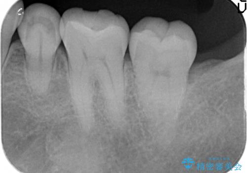 セラミックインレー しみる古い樹脂のやり替えの治療前