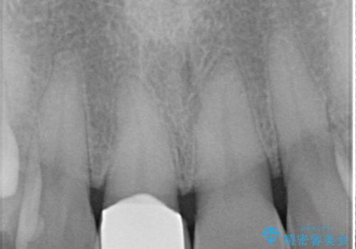 天然歯を模した ハイグレードオールセラミッククラウンの治療後