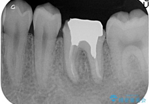 オールセラミッククラウン 治療途中の歯の再治療の治療前