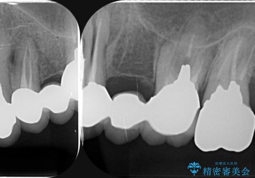 虫歯による歯の喪失 インプラントによる咬合機能回復の治療前