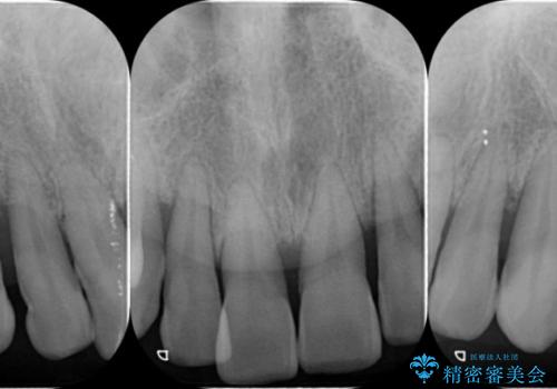 [歯周病治療]  歯周補綴　インプラント補綴の治療前