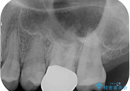 奥歯のむし歯治療 セラミックとゴールドインレーの治療後