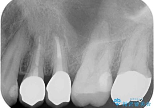 古くなったメタルボンドをオールセラミッククラウンにの治療後
