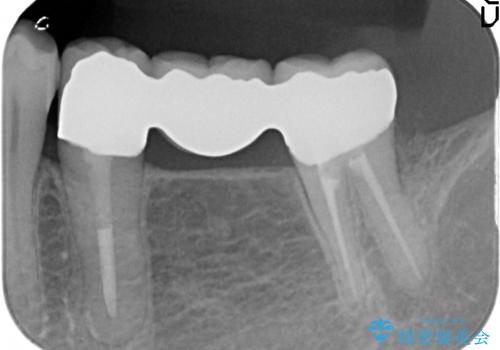 オールセラミッククラウン 欠損補綴と再生療法による深いポケットの改善の治療後