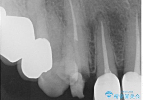 クラウン下に再発した深い虫歯 インプラントによる機能回復の治療前