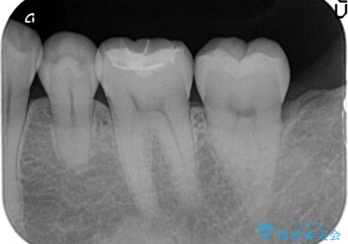 セラミックインレー しみる古い樹脂のやり替えの治療後