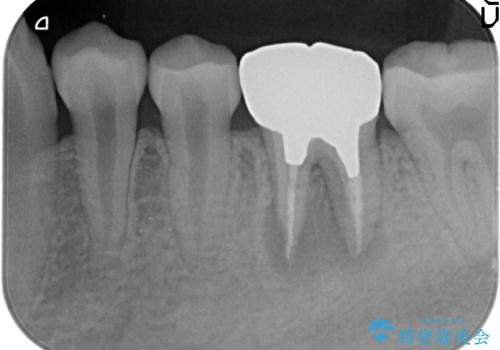 オールセラミッククラウン 他院にて抜歯と言われた歯の治療の治療前