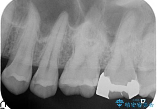 セラミックインレー 虫歯と指摘された奥歯の治療の治療前