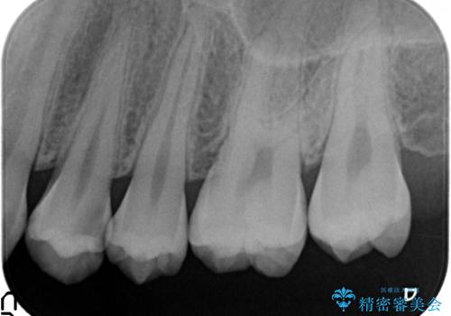 セラミックインレー　虫歯で欠けた歯の治療の治療前