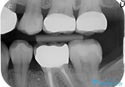 犬歯の変色　マウスピースで手軽にエクストリュージョン　歯ぐきの炎症をおさめますの治療後