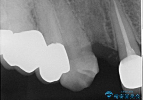 クラウン下に再発した深い虫歯 インプラントによる機能回復の治療中