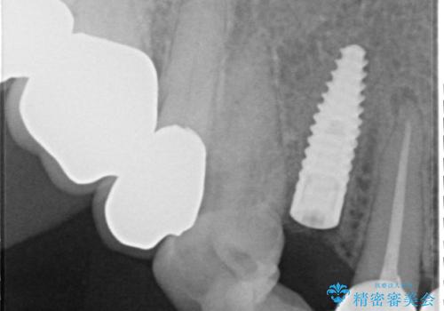 クラウン下に再発した深い虫歯 インプラントによる機能回復の治療中