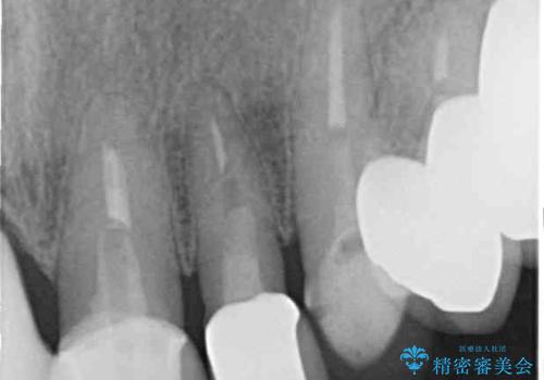 汚れてしまった前歯の仮歯 オールセラミッククラウンにて自然にの治療後