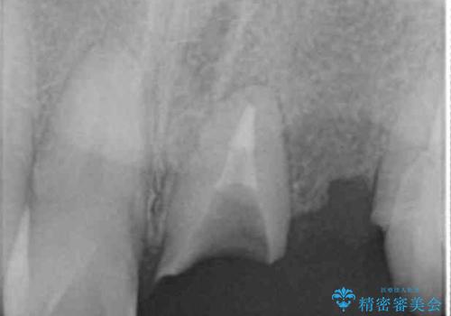 歯が折れた　どうしても抜きたくない　歯の牽引で保存可能にの治療前