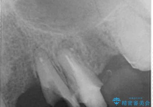 歯が折れた どうしても抜きたくない 歯の牽引で保存可能にの治療前