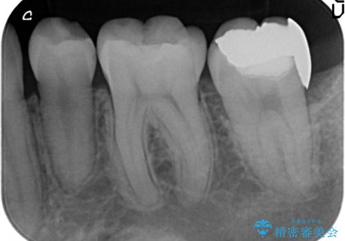 オールセラミッククラウン　奥歯の虫歯・深いポケットの除去の治療前