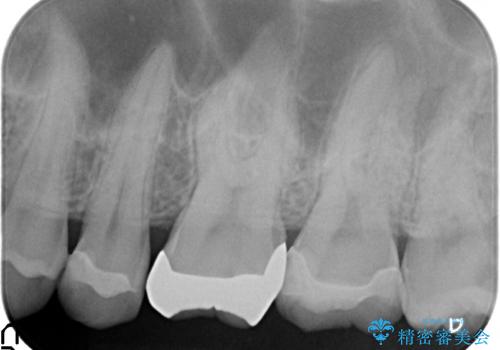 セラミックインレー 虫歯と指摘された奥歯の治療の治療後