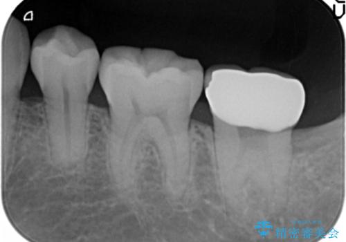 他院で次に虫歯になったら治せないと言われた　歯周外科手術でしっかり治療(APF)の治療後