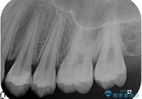 セラミックインレー　虫歯で欠けた歯の治療の治療後