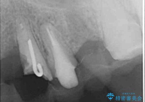 歯が折れた どうしても抜きたくない 歯の牽引で保存可能にの治療前