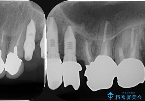 虫歯による歯の喪失　インプラントによる咬合機能回復の治療中