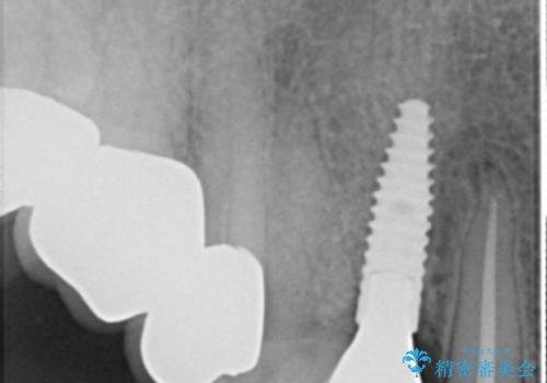 クラウン下に再発した深い虫歯 インプラントによる機能回復の治療後