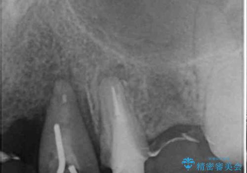 歯が折れた どうしても抜きたくない 歯の牽引で保存可能にの治療後