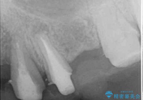 歯が折れた　どうしても抜きたくない　歯の牽引で保存可能にの治療後