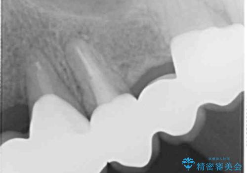 歯が折れた どうしても抜きたくない 歯の牽引で保存可能にの治療後