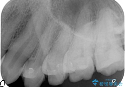 3本仮づめのまま放置 セラミックインレーへの治療前