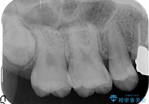 セラミックインレー 痛む歯の治療の治療前