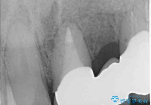 歯が折れた どうしても抜きたくない 歯の牽引で保存可能にの治療後