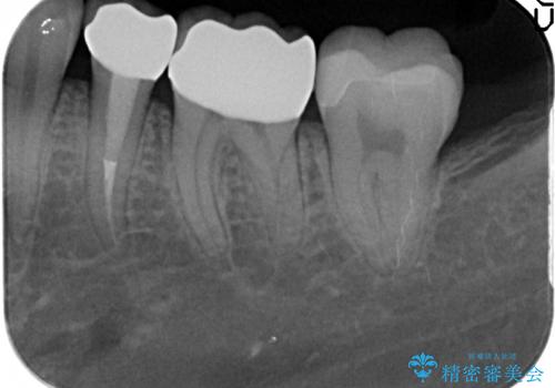 オールセラミッククラウン セラミックインレー 銀歯を白い歯への治療後