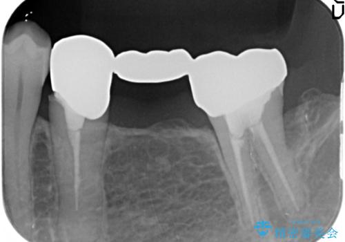 オールセラミッククラウン 欠損補綴と再生療法による深いポケットの改善の治療前