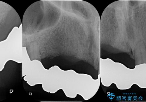 咬合性外傷による歯槽骨吸収 ブリッジ補綴の治療中