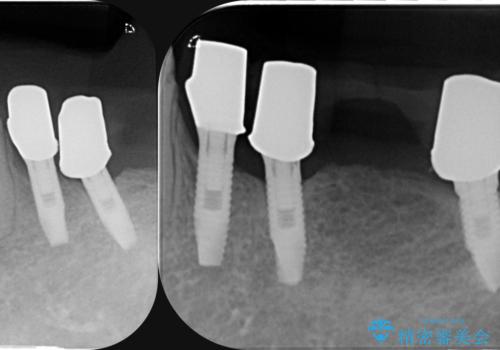 虫歯による歯の喪失　インプラントによる咬合機能回復の治療中