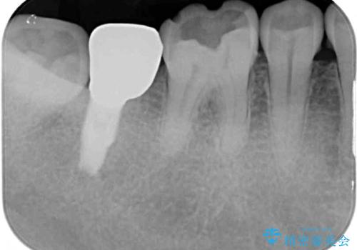 外れてしまった奥歯の銀歯 ゴールドインレーによる虫歯復療の治療前