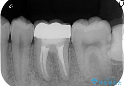 オールセラミッククラウン 治療途中の歯の再治療の治療後