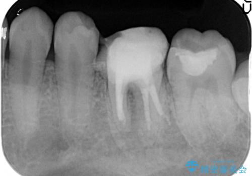 放置してしまった歯 根管治療からの機能回復の治療中