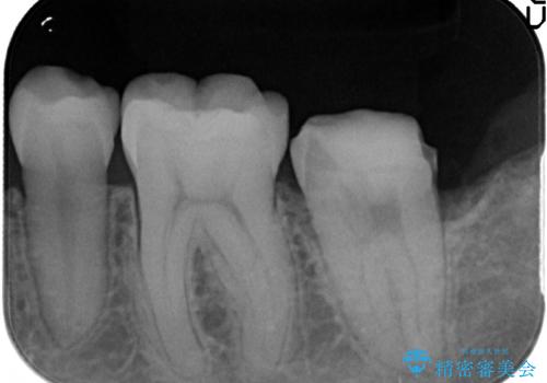 オールセラミッククラウン 奥歯の虫歯・深いポケットの除去の治療後