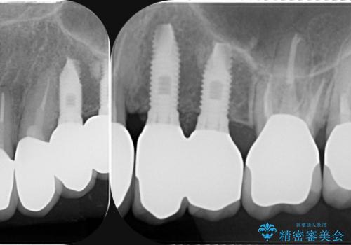 虫歯による歯の喪失　インプラントによる咬合機能回復の治療後