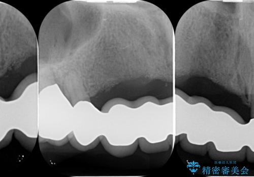 咬合性外傷による歯槽骨吸収 ブリッジ補綴の治療後