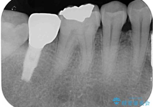 外れてしまった奥歯の銀歯 ゴールドインレーによる虫歯復療の治療後