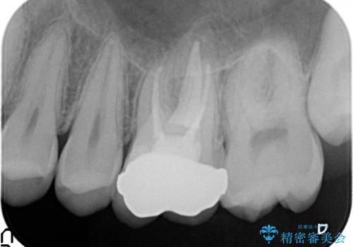 オールセラミッククラウン ズキズキ痛む歯の治療の治療後
